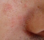 dermatitis seborreica