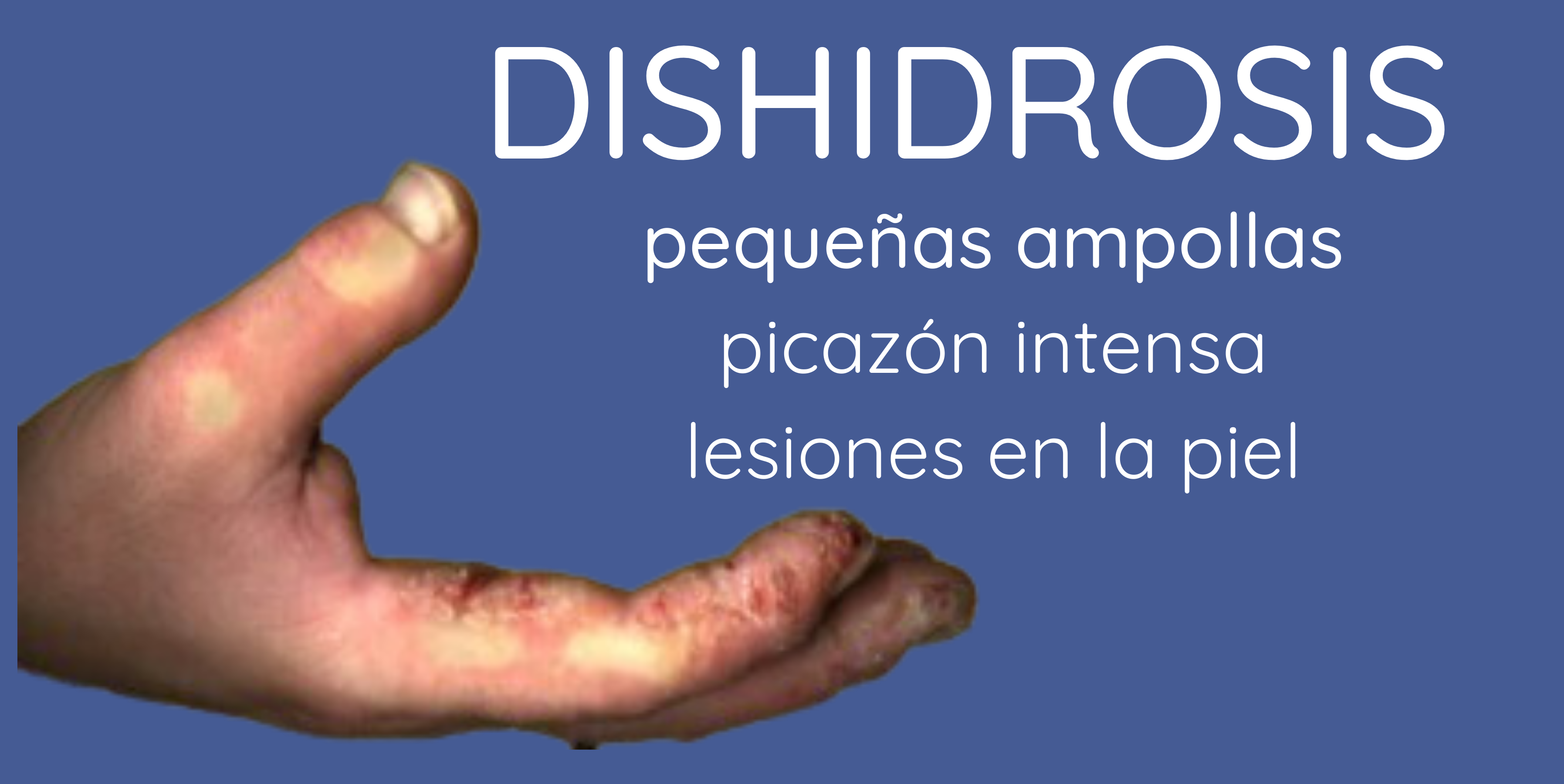 Dishidrosis en manos: pequeñas ampollas, picazón intensa y lesiones en la piel.