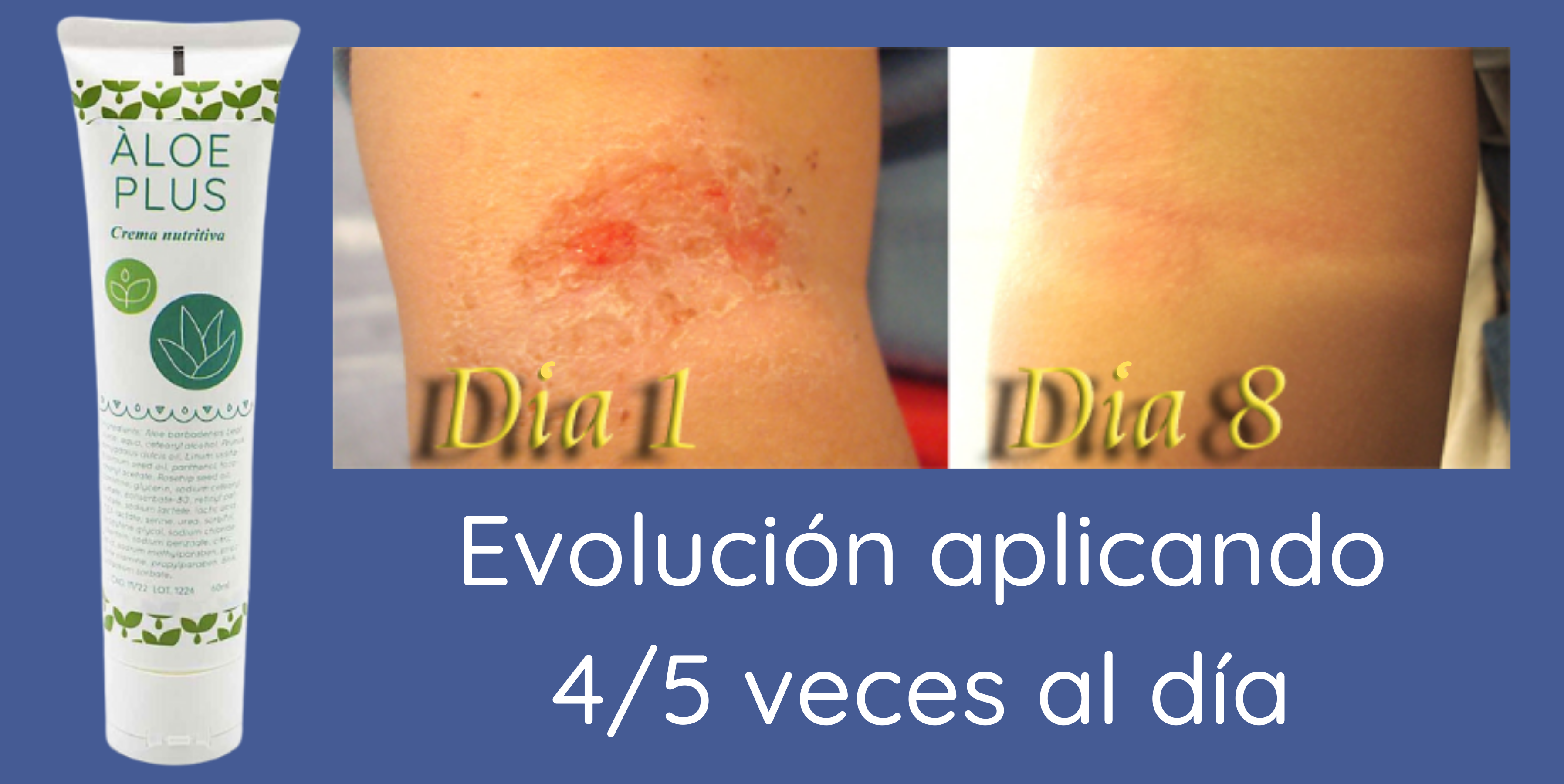 Crema nutritiva áloe plus 1842 efecto sobre una placa de psoriasis local en una pierna, espectacular.