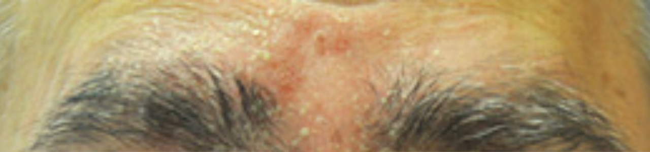 dermatitis seborreica en cejas.