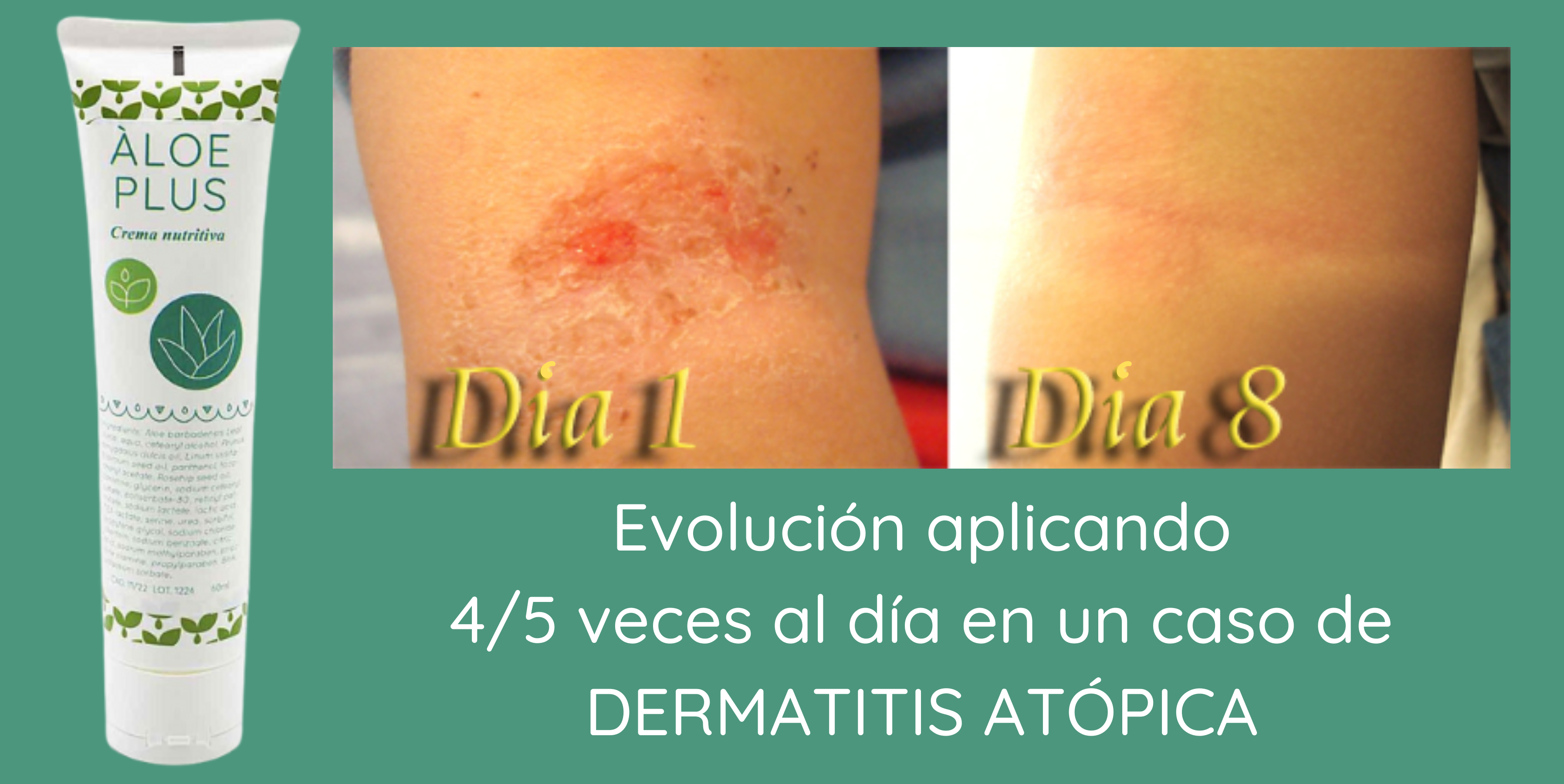 Crema nutritiva áloe plus 1842 efecto sobre un brote local de dermatitis atópica en un niño en pliegue de brazo.