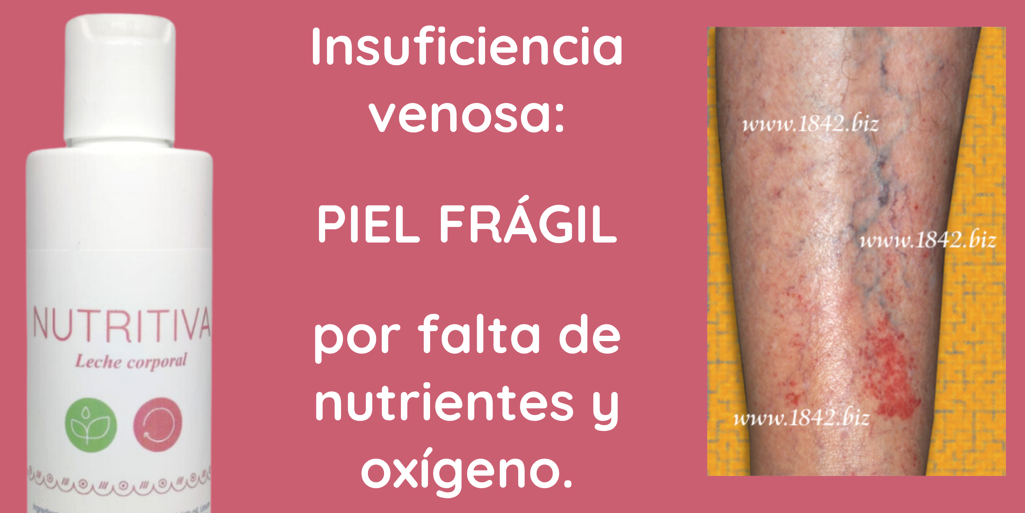 Leche corporal nutritiva 1842 para insuficiencia venosa de piernas.