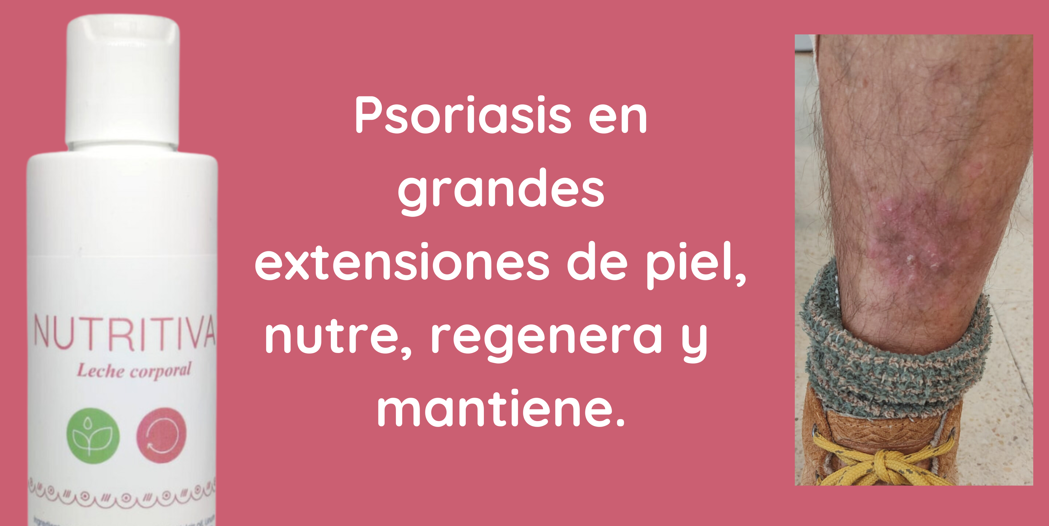 Leche corporal nutritiva 1842 nutre, regenera y protege la piel con psoriasis en grandes extensiones.