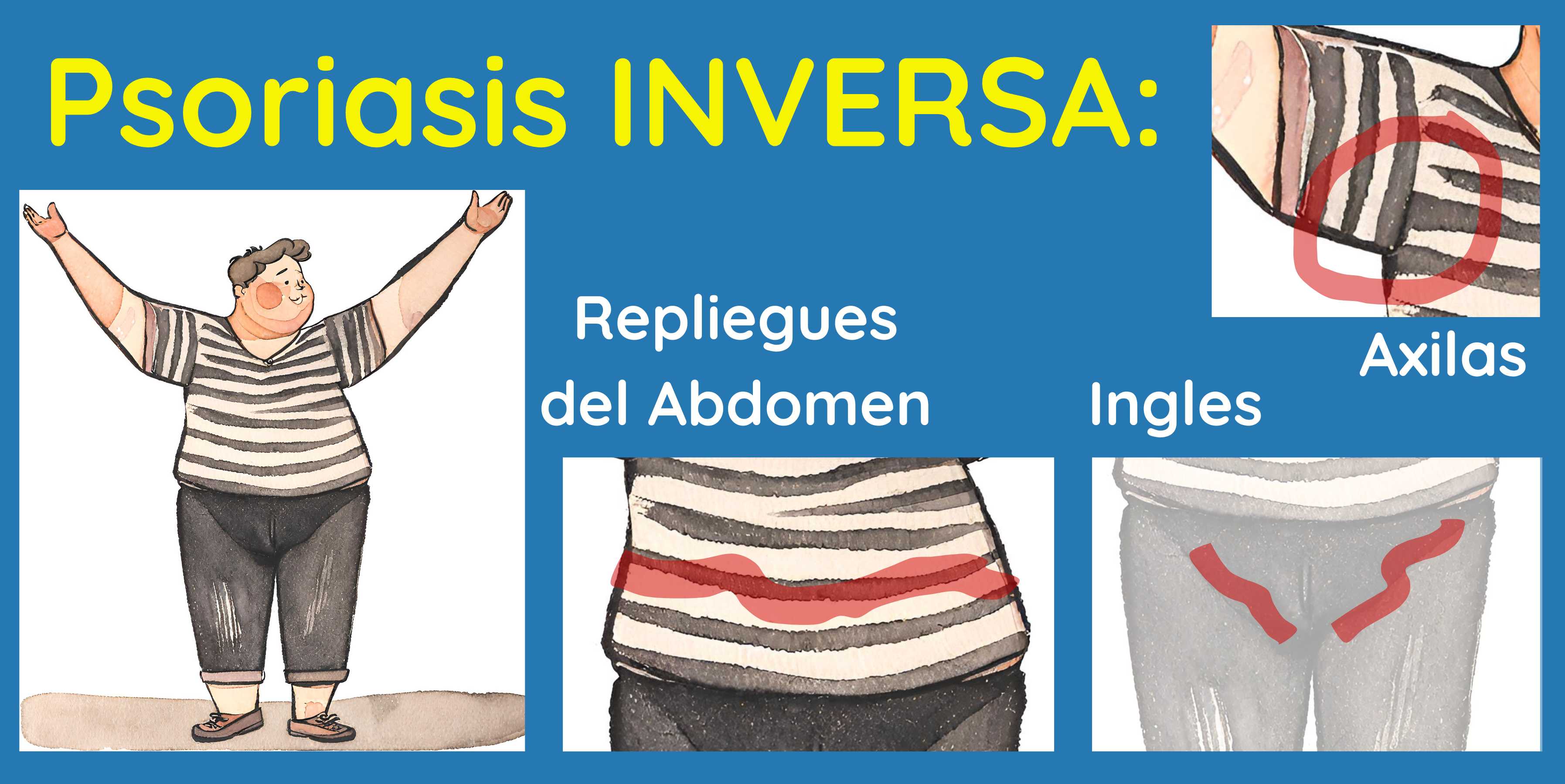 Psoriasis inversa en casos de obesidad también puede afectar en los pliegues abdominales.