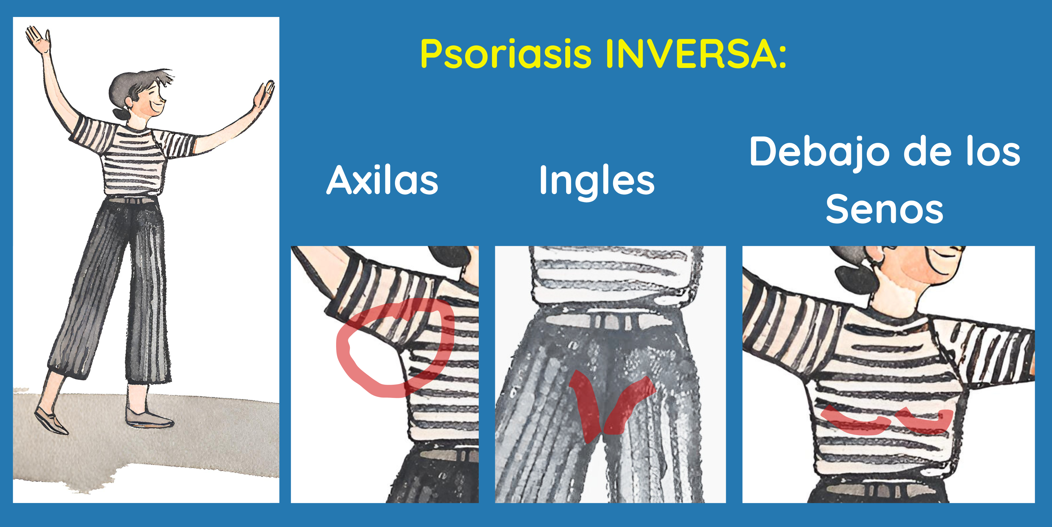 Psoriasis inversa se localiza en axilas, bajo pechos e ingles.