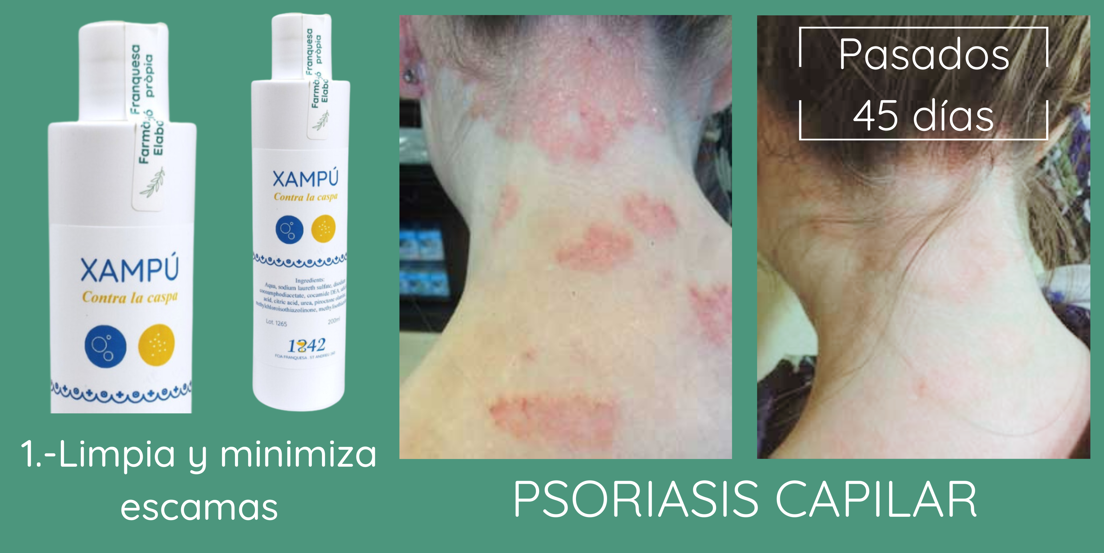psoriasis capilar: buena resolución con el champú contra la caspa 1842 y la crema prevent age 1842