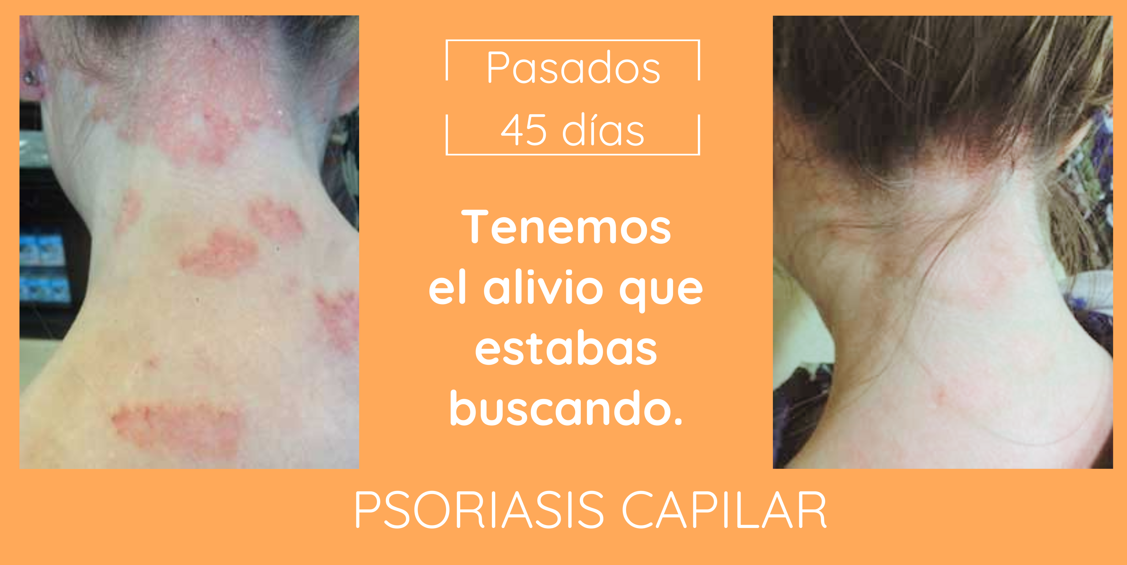 psoriasis capilar el alivio que buscabas