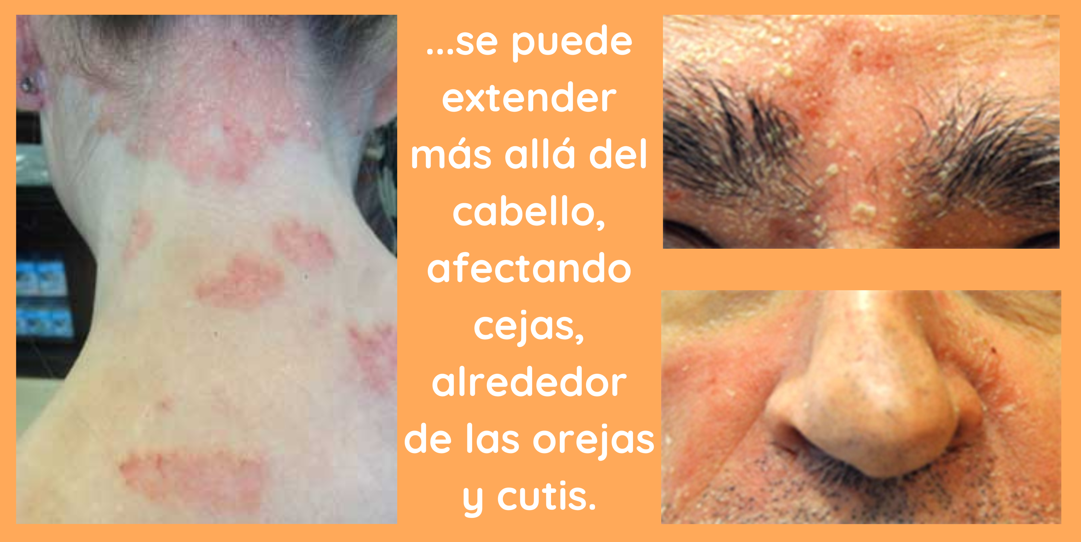 la psoriasis capilar se puede extender al cutis y a las orejas