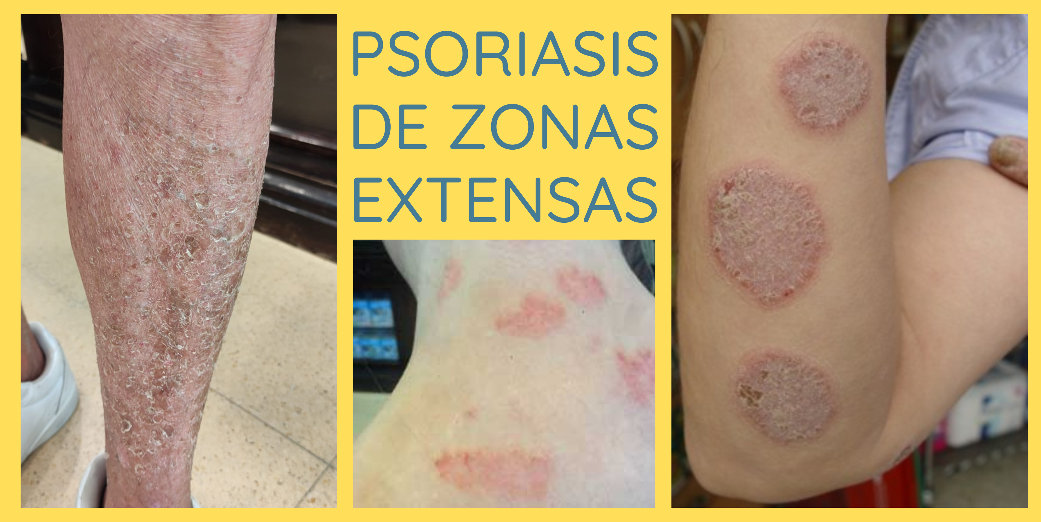 psoriasis en zonas amplias