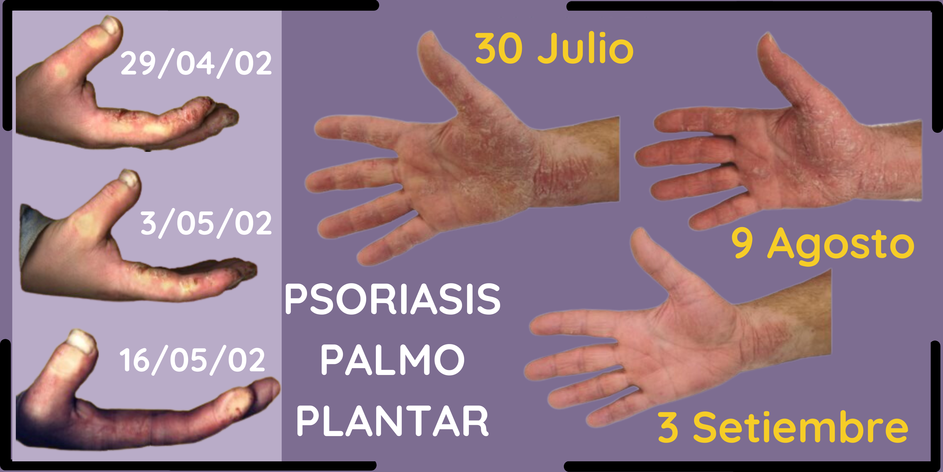 2 casos de psoriasis en palma de las manos