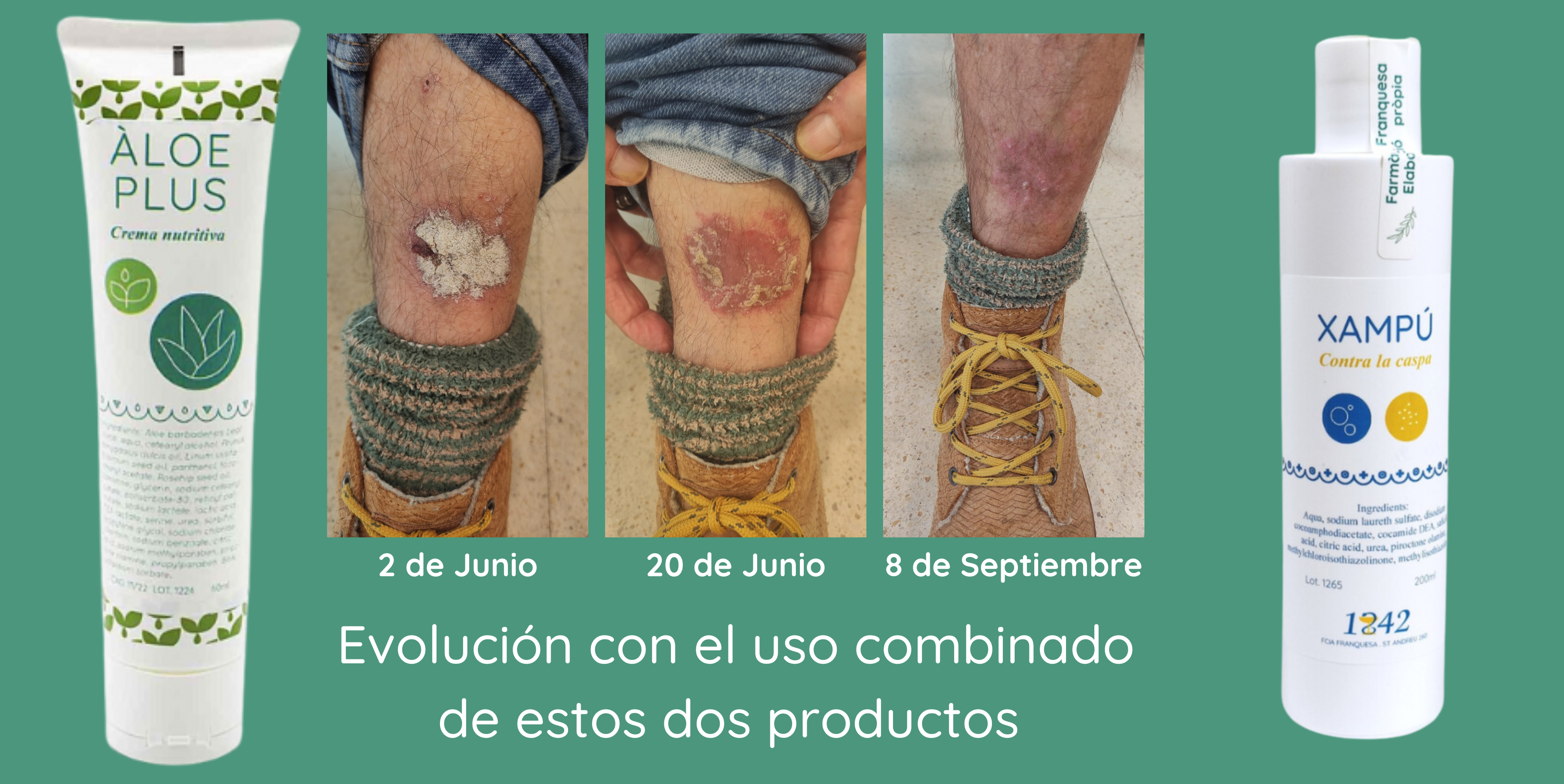 evolución de una placa de psoriasis en pierna, la placa gruesa se reduce hasta no dejar casi señal visible.