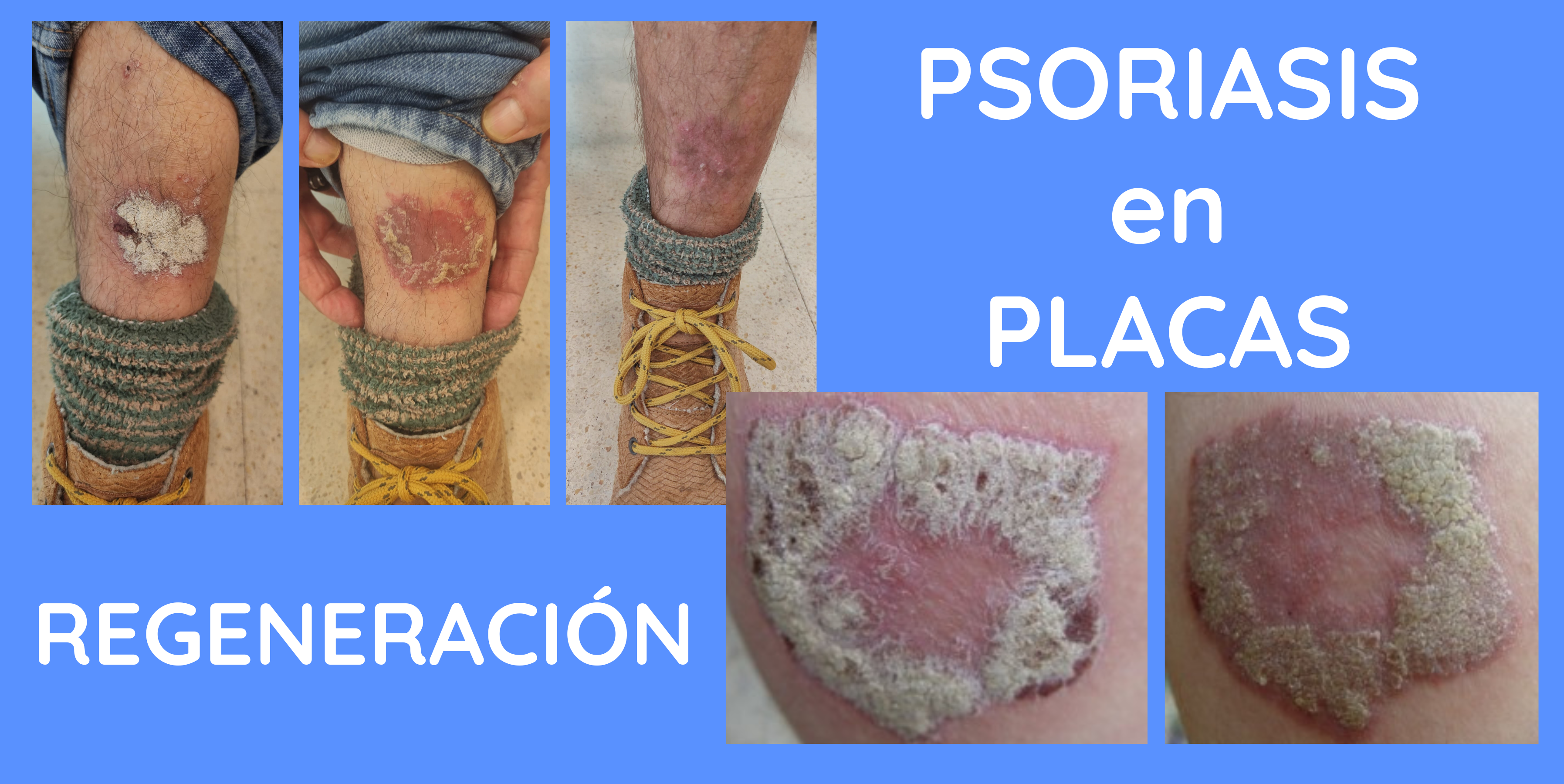 psoriasis en placas locales e intensas