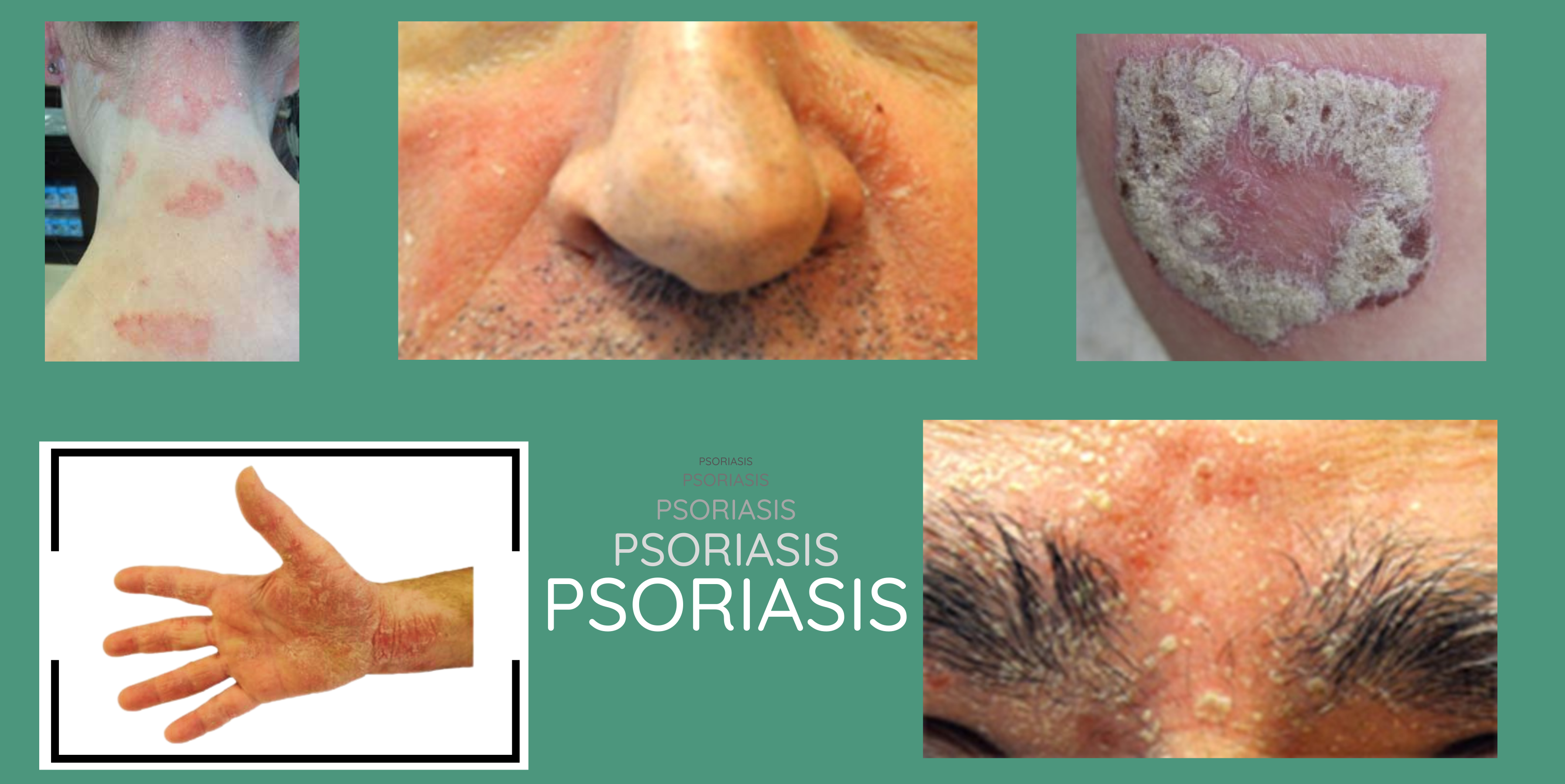 imagenes de casos de psoriasis: capilar, facial, placas, manos